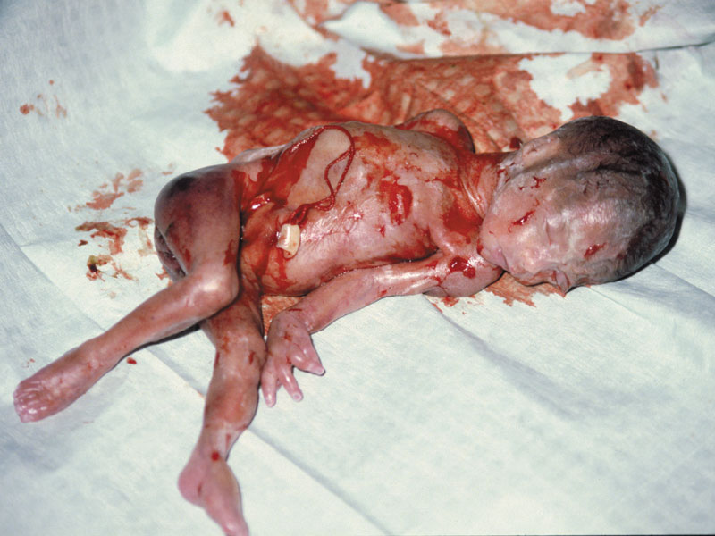 abortion_22_weeks01.jpg